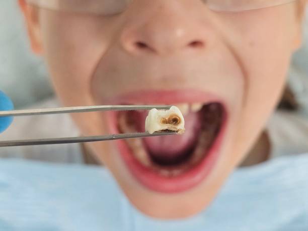 Best Pediatric Emergency Dentist in Williamsville, NY
